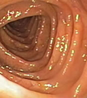 A section of my colon with mild diverticulosis.