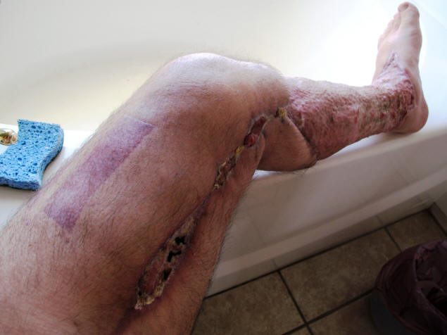 My leg as of May 3rd.