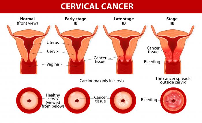 Cervical Cancer diagram.